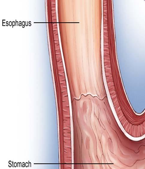 LINITIS PLASTICA Spreads to the muscles of the stomach wall and makes it thicker and more rigid.