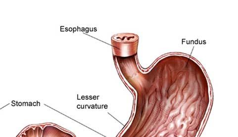 BARRETT S ESOPHAGUS Repeated exposure to acidic stomach contents washing back (refluxing) through