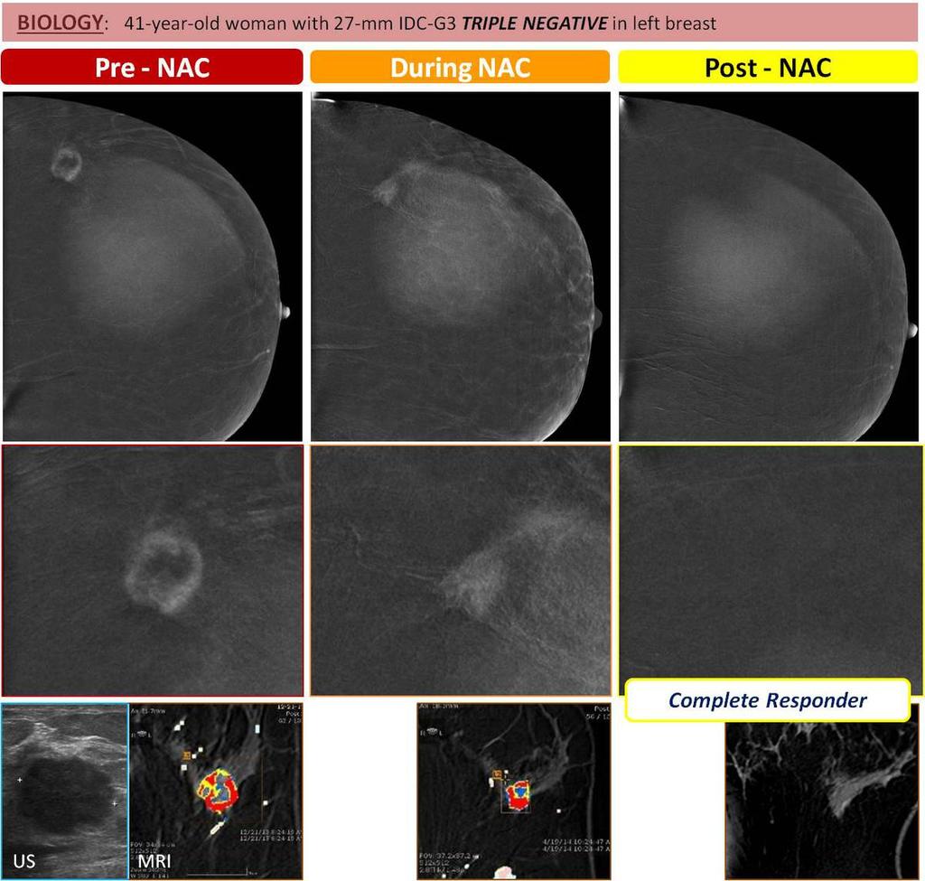 Fig. 13: 41-year-old woman with 27-mm IDC-G3 Triple Negative in left breast.