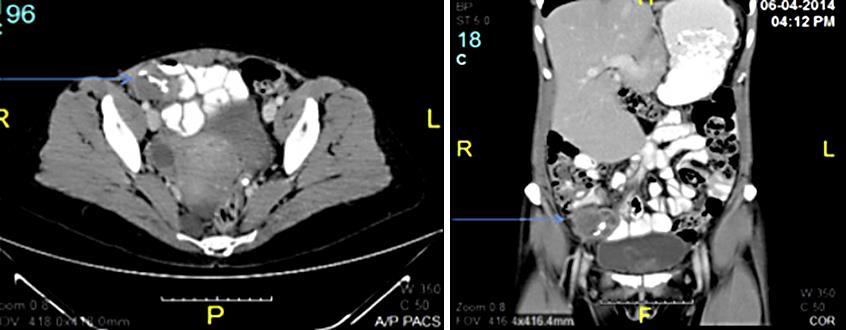 470 Fig. 1. CT of the abdomen and pelvis with contrast of the patient.