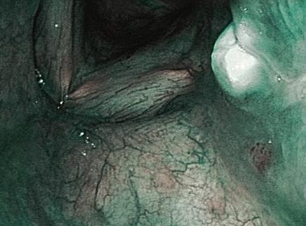 ose More Laryngeal Cancer Particularly when combined with a high resolution (e.g. HDTV), NBI can provide a more-detailed and higher-contrasted visualization of blood vessels than other endoscopic procedures.