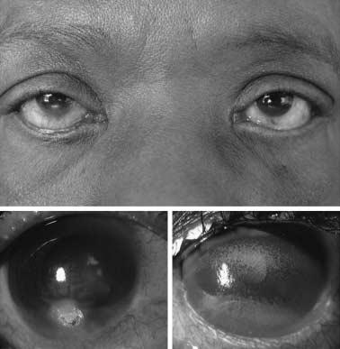 Surgical treatment of bilateral paralytic lagophthalmos 449 Figure 1. (A) Lagophthalmos and lateral ectropion at the time of first presentation.