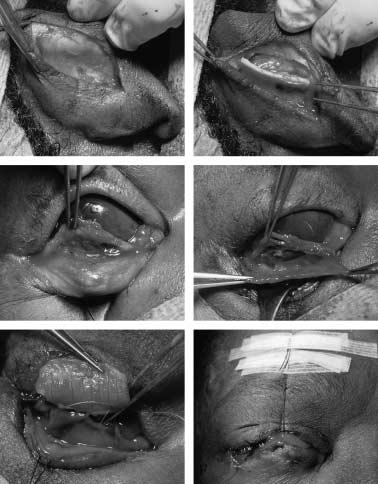 450 L. Lavilla et al. Figure 2. Description of the surgical procedure. (A) Incision in the posterior side of the ear. (B) Obtaining auricular cartilage from the scapha.
