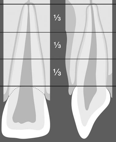 Intraoral radiography vs. CBCT for assessing root fractures 573 Fig. 1. Schematic illustration of the classification of the different root fracture levels (apical, middle, cervical third of the root).
