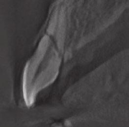 574 Bornstein et al. (a) (b) (c) (d) Fig. 3. (a) In a 36-year-old patient, a root fracture can be seen in the middle third of the left central maxillary incisor on the occlusal radiograph.