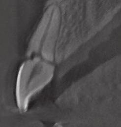 (c) The sagittal cone beam computed tomography (CBCT) slice shows the cervical location of the root fracture in the right central maxillary incisor (cervical third on facial and palatal aspects).