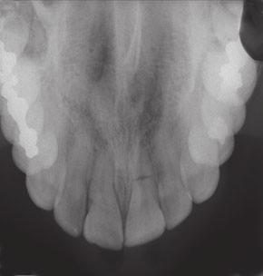 18%) PA, periapical; OC, occlusal, CBCT; cone beam computed tomography. (Table 4).