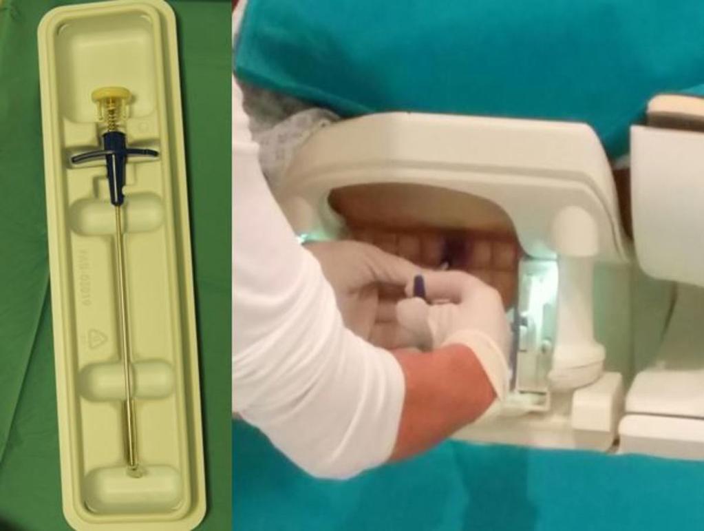 Fig. 6: Marker placed in biopsy site,