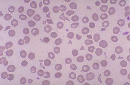 Anemia hemolytic