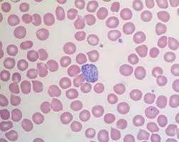 Anemia  of plasmodium