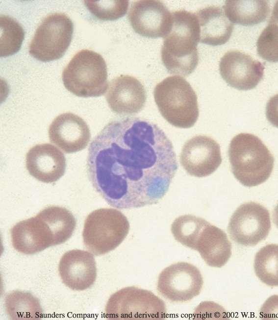 Dohle bodies neutrophil Sky blue inclusions in cytoplasm of neutrophils, seen in