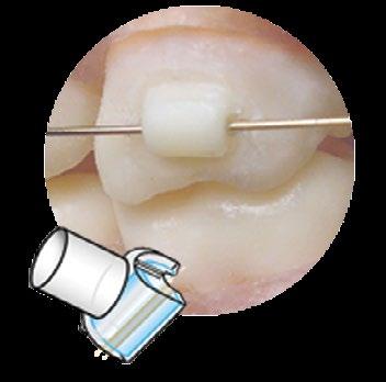 Tips Designed to create a temporary tube DB09-0258 Posterior Molar Pad