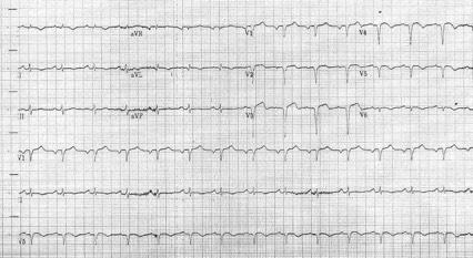 o o o o o 51 year-old-patient 1 month ago acute anterior myocardial infarction treated with
