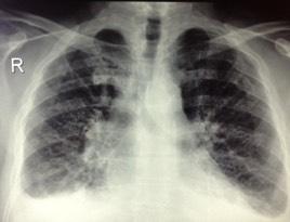 with antibiotics Discharged 2 weeks later with EF~30, without pericardial-pleural effusion,