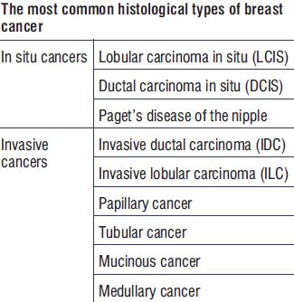 Histology of breast tumours Adenocarcinoma arising from glandular breast