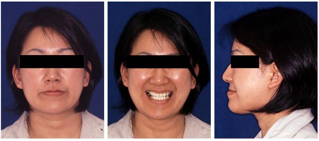 Nahoko Imai et al. ว ออนไลน ท นต จ ดฟ น ป ท 2 2555 Clinical examination Her profile was concave due to mandibular protrusion.