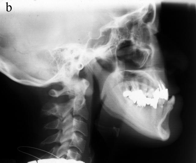 O J Thai Assoc Orthod Vol 2 2012 Nahoko Imai et al. Radiographic examination From the panoramic X-ray, a moderate degree of resorption was seen in the alveolar bones.