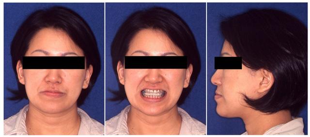 O J Thai Assoc Orthod Vol 2 2012 Nahoko Imai et al. orthodontic treatment (Figures 4,5), mandibular back ward repositioning by 9.0 mm. on the left, 11.0 mm. on the right and a 7.