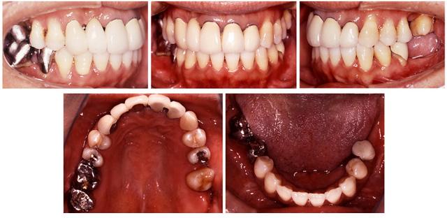 46, 47, and dental implants for the mandibular left quadrant after six months of the retention phase.