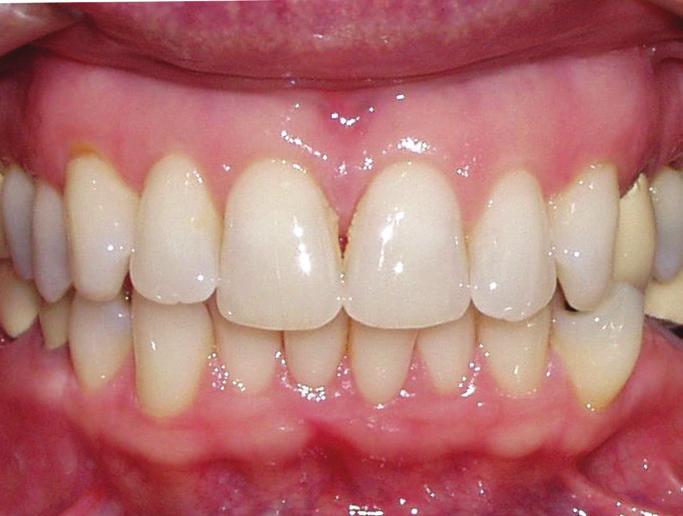 Case 3: Removal of a lower incisor Fig. 4a: Primarily upper crowding with much lower irregularity.