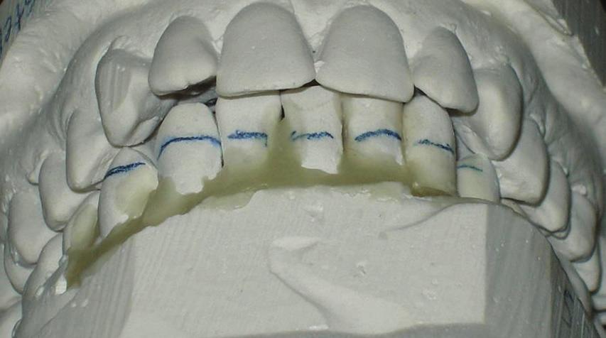 After reviewing the casts, it was clear that a lower incisor extraction would not result in excessive