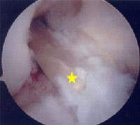 Arthroscopic view of ACL graft [yellow star] in position. After the graft has been prepared, the surgeon places an arthroscope into the joint.