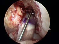 tunnel low and horizontal in orientation (Bach AJSM 1994) Surgical morbidity high 8 12% flexion contracture Most revision procedures were