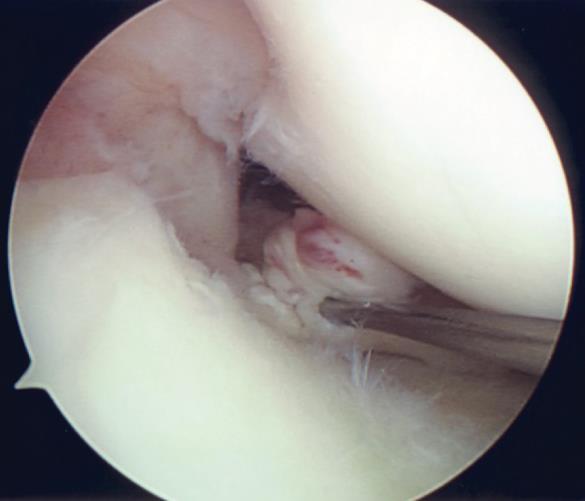 Meniscal Root Tears: Evaluation, Imaging, and Repair Techniques R O B E R T N A S