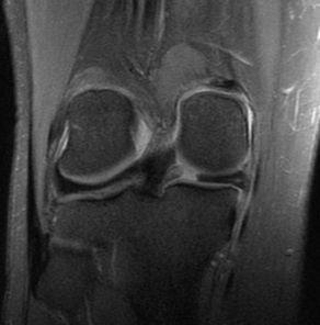 Medial Meniscal Root Tears Reported from 3% up to 21% in the literature in differing series