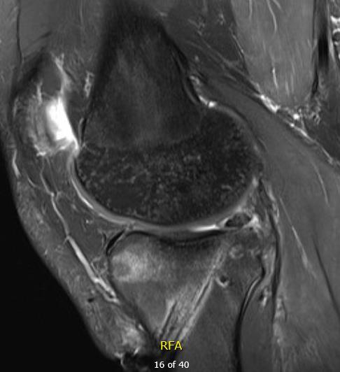 Meniscal Root Repair PROS Maintain hoop strains Preserve articular cartilage by dispersing contact pressures Minimize