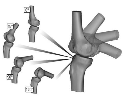 Posterior Root Tear: Diagnosis High Suspicion in patients with posterior knee pain Effusion +/- Painful flexion