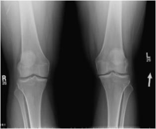 expansion X-rays -- True lateral (tib.