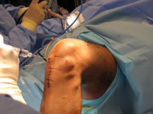 Technical considerations in ACL revision surgery Skin incision; placement may allow simultaneous: Graft harvest Drilling of the Tib.