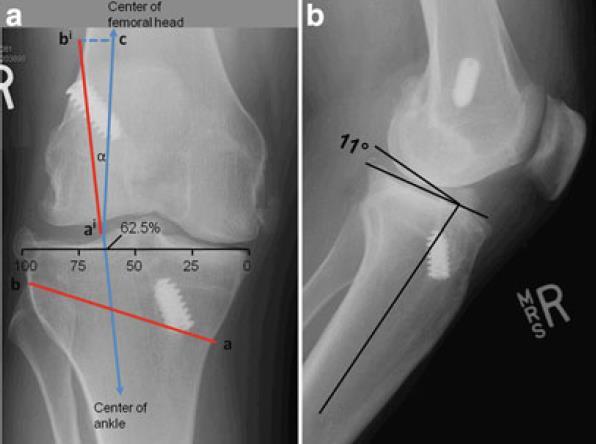 Technical considerations in ACL revision surgery Associated surgical procedures Osteotomy (malalignment) Slope & Coronal Plane Posterolateral reconstruction Double & Triple