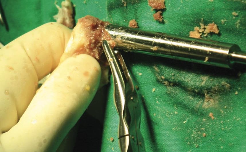 Achilles Allograft with