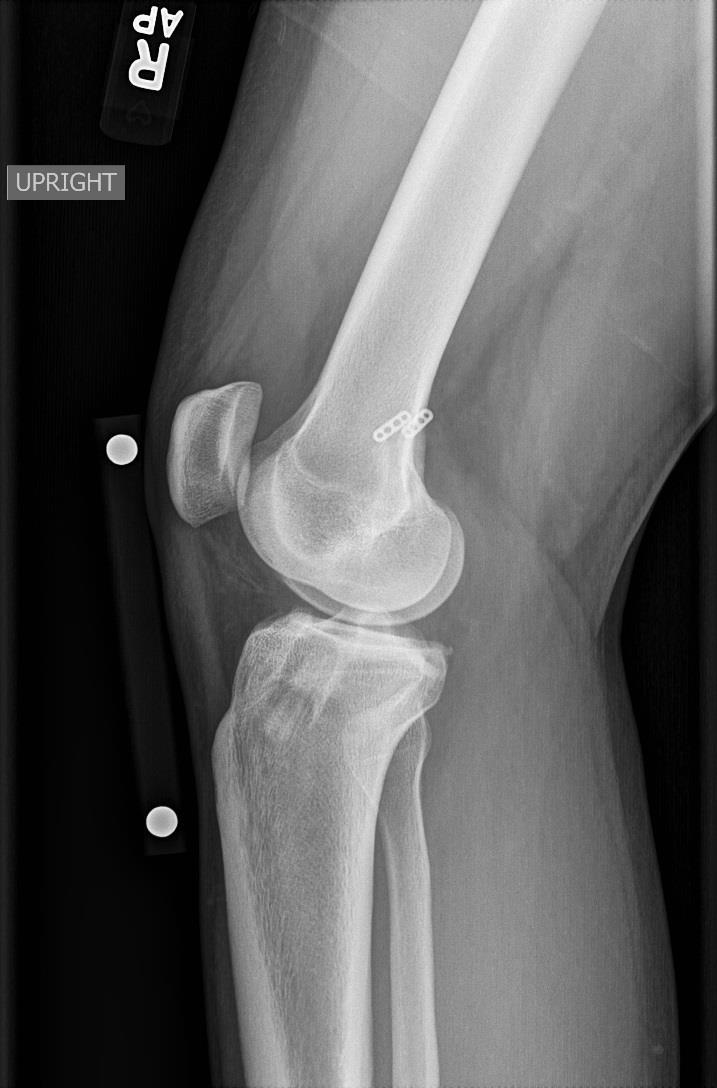 Recurrent ACL Instability 18 y male Soccer athlete Non-contact ACL injury 2 prior ACL reconstruction Autograft ACL (14 y)