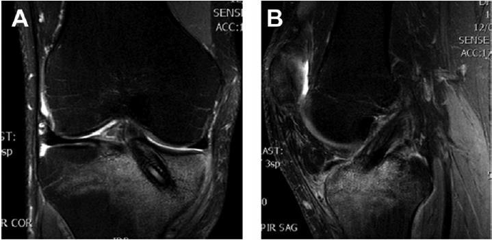 Differentiating Occult Propionibacterium acnes Infection From Aseptic Biologic Interference Screw Hydrolysis After ACL Reconstruction.