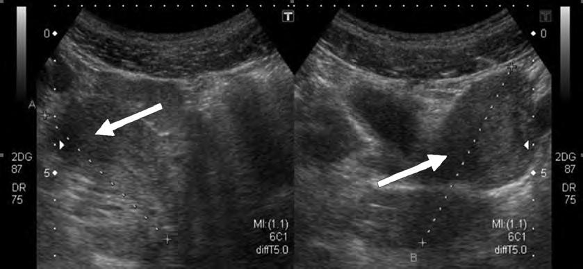 Paediatrics Today 2016;12(1):87-91 Case report An 11-year-old female presented with a history of severe abdominal pain that occurred shortly following menarche.