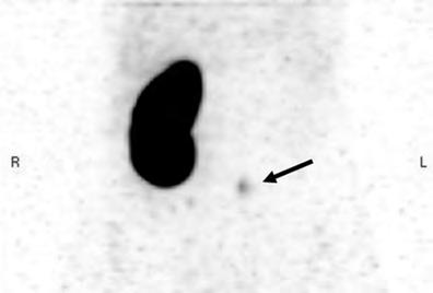 3 Tc-99m DMSA scintigraphy followed by a SPECT/CT confirmed small functioning renal remnant (arrow). Fig. 4 Ectopic dysplastic kidney after laparoscopic removal.