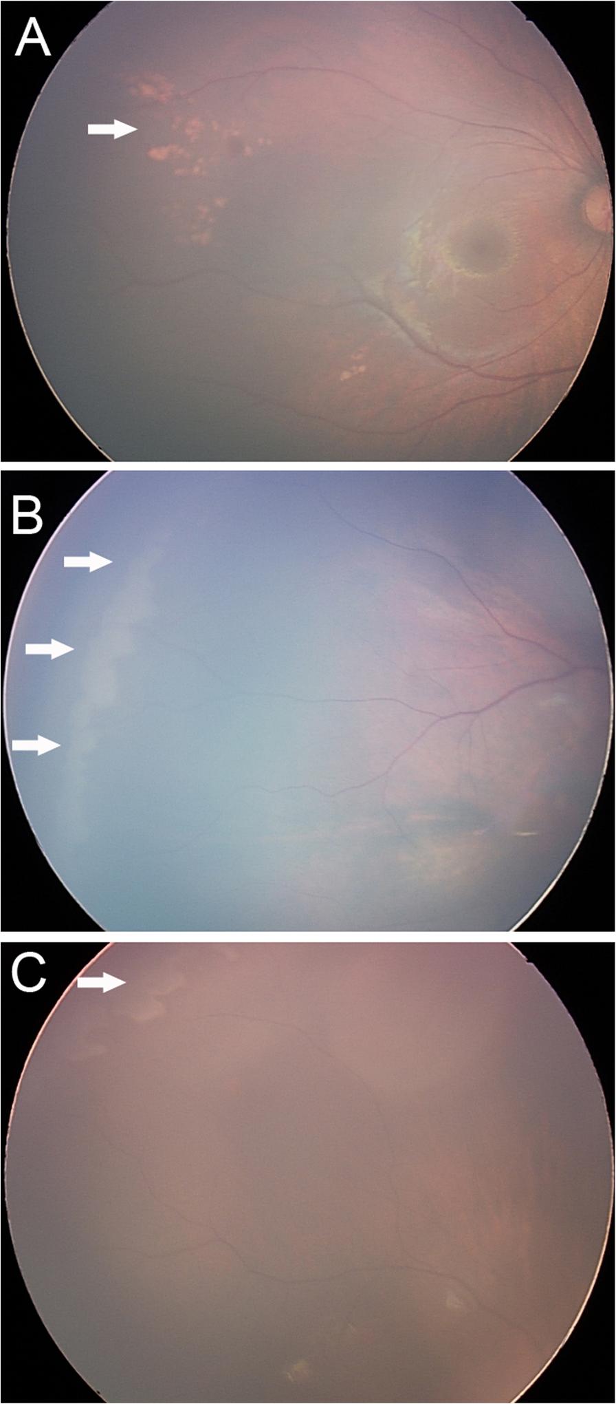 Ma et al. BMC Ophthalmology (2018) 18:283 Page 3 of 8 Fig. 2 Concomitant exotropia was seen in 3.