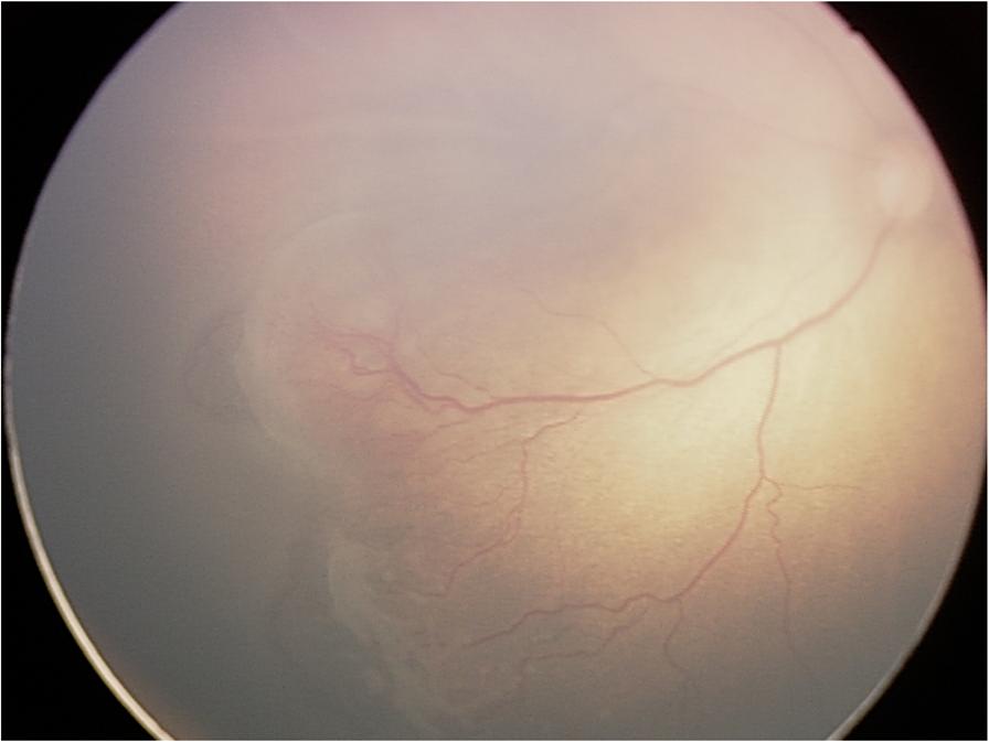 2%) had the retinal white spot without any change at 12 months of age. Of 32 cases and 39 eyes with retinal hemorrhages, 29 eyes (74.4%) had grade 1, 9 eyes (23.1%) had grade 2, and one eye (2.