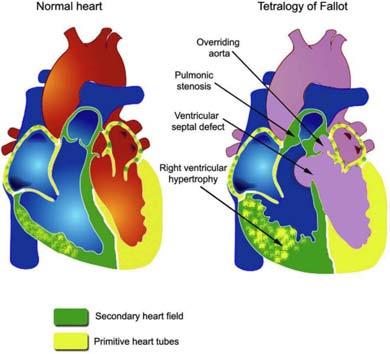 The second heart field and conotruncal congenital heart