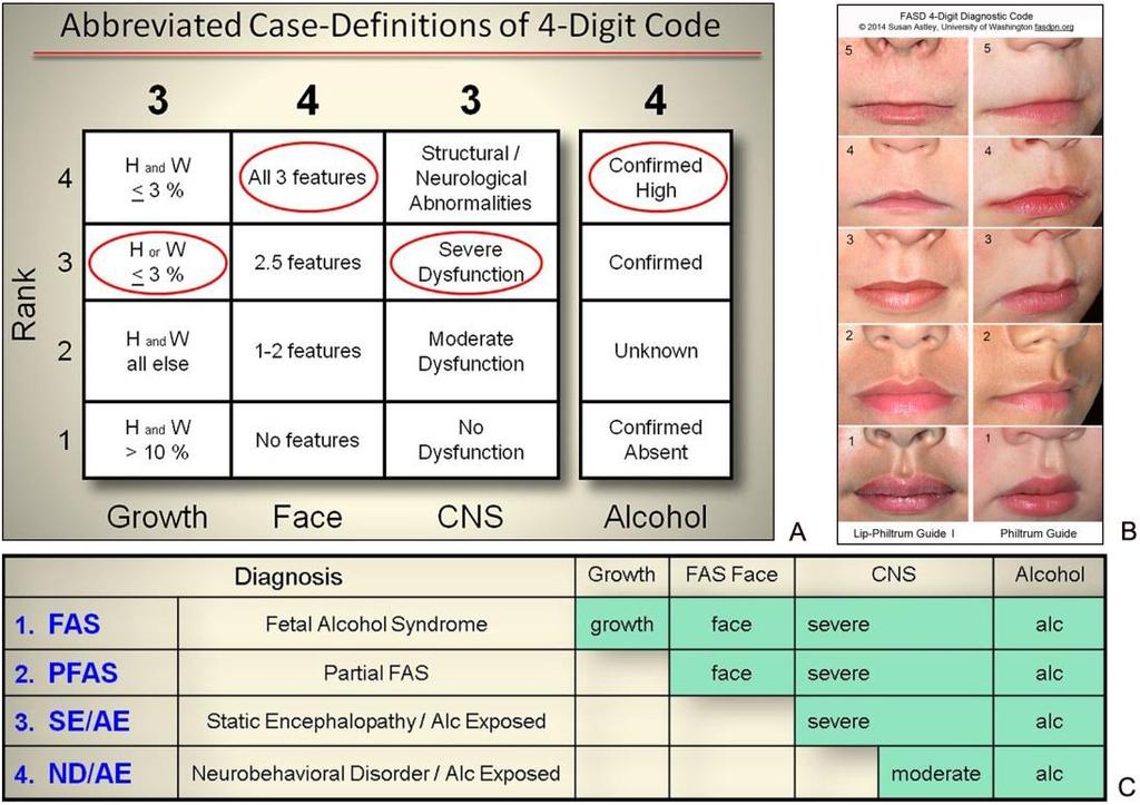 4-Digit Codes within each FASD Diagnostic Category Figure1: FASD 4-Digit Diagnostic Code. A) Abbreviated case-definitions for the fetal alcohol spectrum disorder (FASD) 4-Digit Code [2].