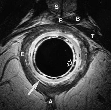 Fig. 19. Endoanal axial oblique T2-weighted turbo spin-echo orthogonal to the axis of the anal canal in a male volunteer (inferior to Fig. 30).
