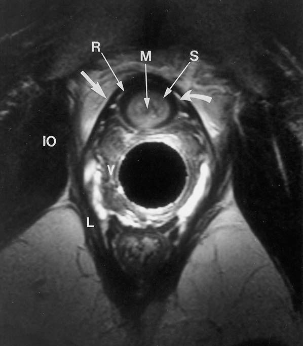 mucosa/submucosa, A anus). The transverse perinei (T) and external anal sphincter (E) are part of the midline perineal body. Reprinted with permission from Tan et al. (1998) Fig. 22.