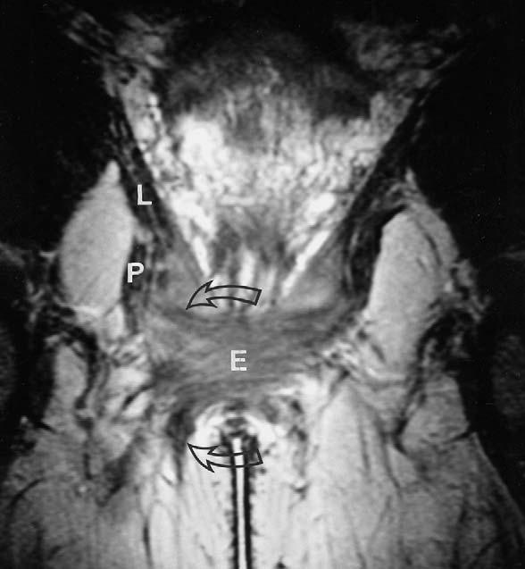 woman at a higher level than Fig. 31 (arrows external sphincter, V vagina) Fig. 33.