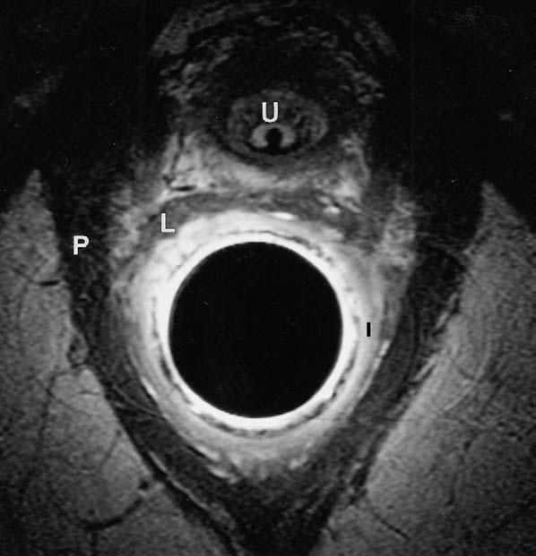 Note the difference in orientation of the external sphincter (E) and pubovisceralis (P) (A anterior, L levator