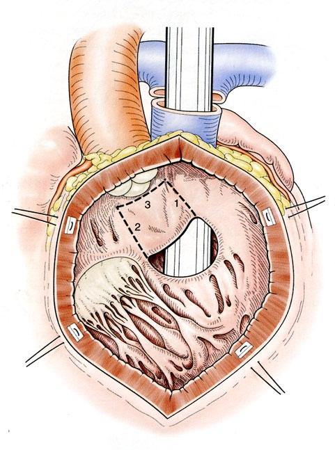 extra-anatomic repair : REV conal