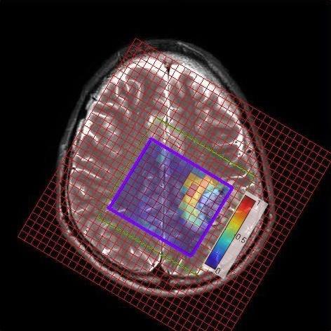 Unsupervised Brain Tumor Diagnosis using NMF MRSI Y = matrix of spectra, Y W H