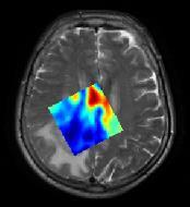 2013) Y = Coregistered MP-MRI data NMF (2 sources) W